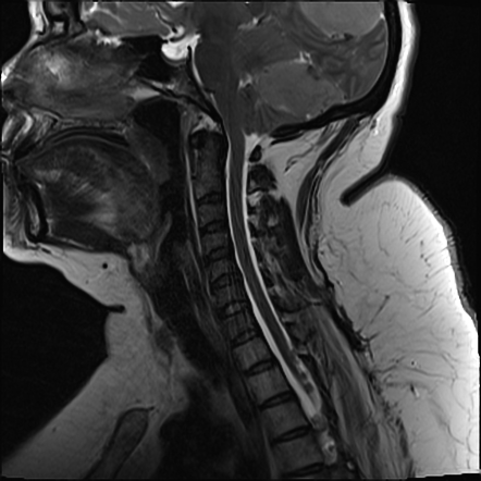 Meningiomatosis | Image | Radiopaedia.org