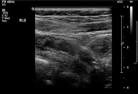 Acute Appendicitis | Radiology Case | Radiopaedia.org