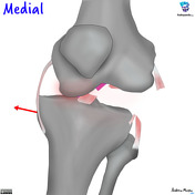 Knee dislocation | Radiology Reference Article | Radiopaedia.org