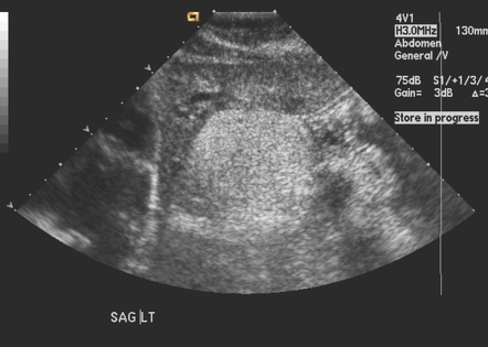 Hepatic angiomyolipoma | Radiology Case | Radiopaedia.org