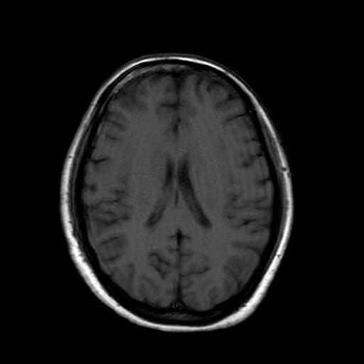 Creutzfeldt-Jakob disease | Image | Radiopaedia.org