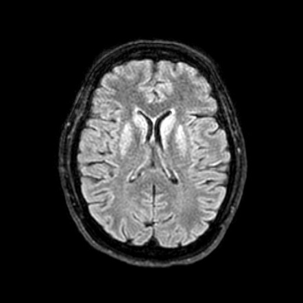 Creutzfeldt-Jakob disease | Image | Radiopaedia.org