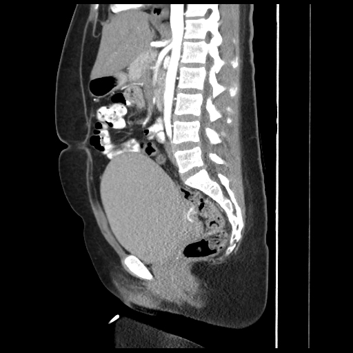 Celiac artery compression syndrome | Image | Radiopaedia.org