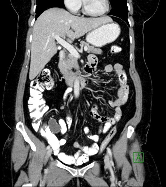 Low-grade appendiceal mucinous neoplasm | Radiology Reference Article ...