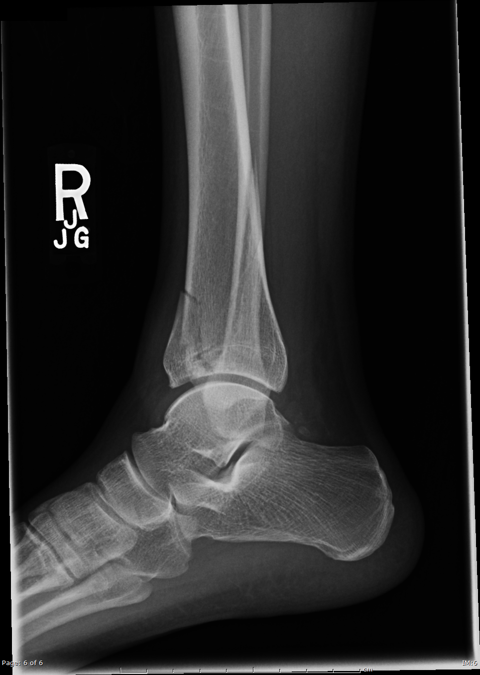 Pilon Fractures - Bilateral | Image | Radiopaedia.org