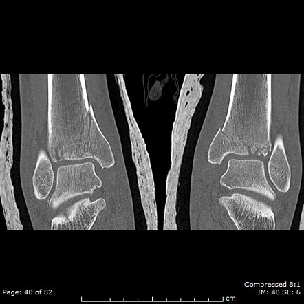 Pilon Anatomy