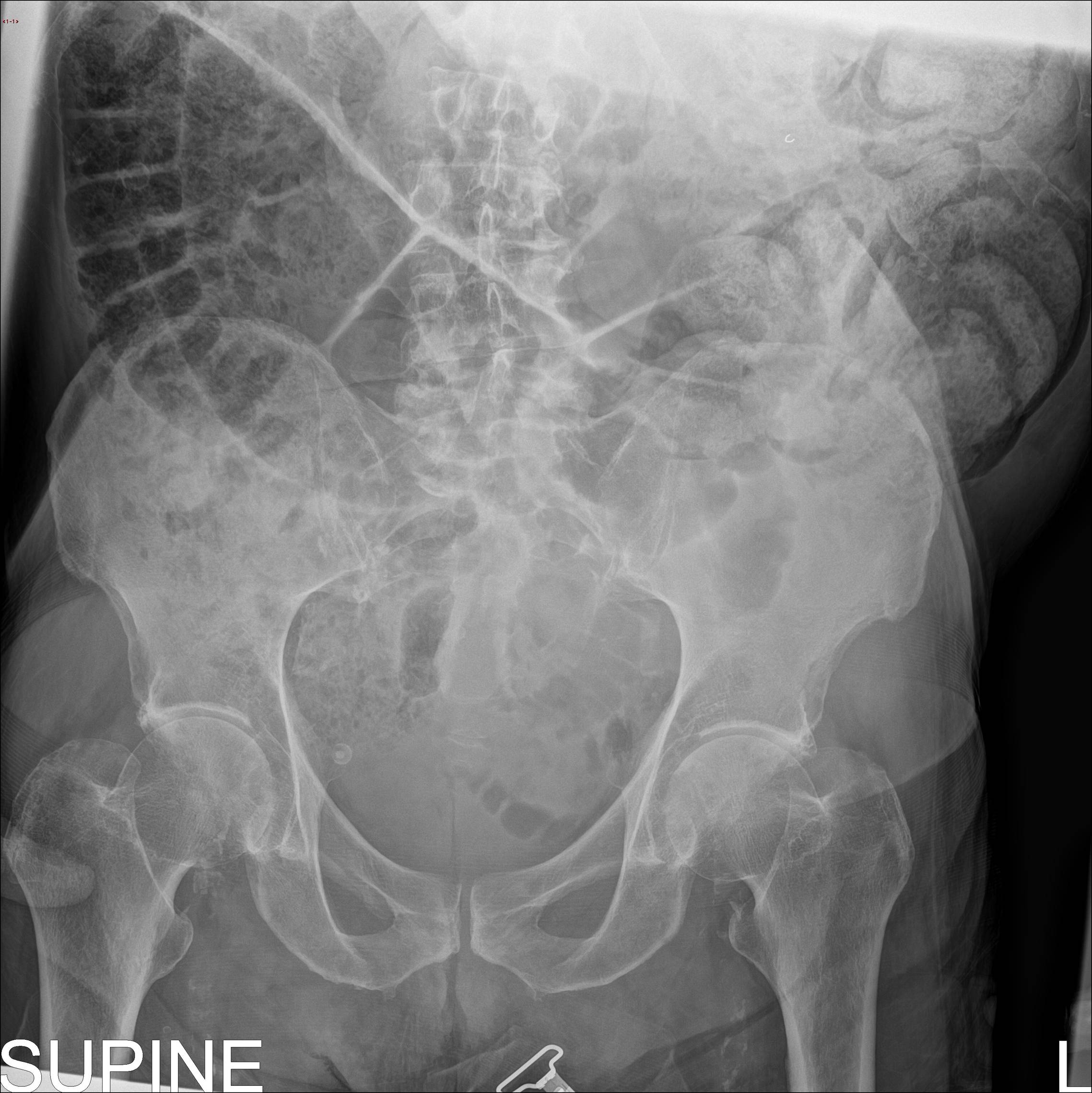 Wandering liver, dolichosigma, and paravertebral mass | Image ...