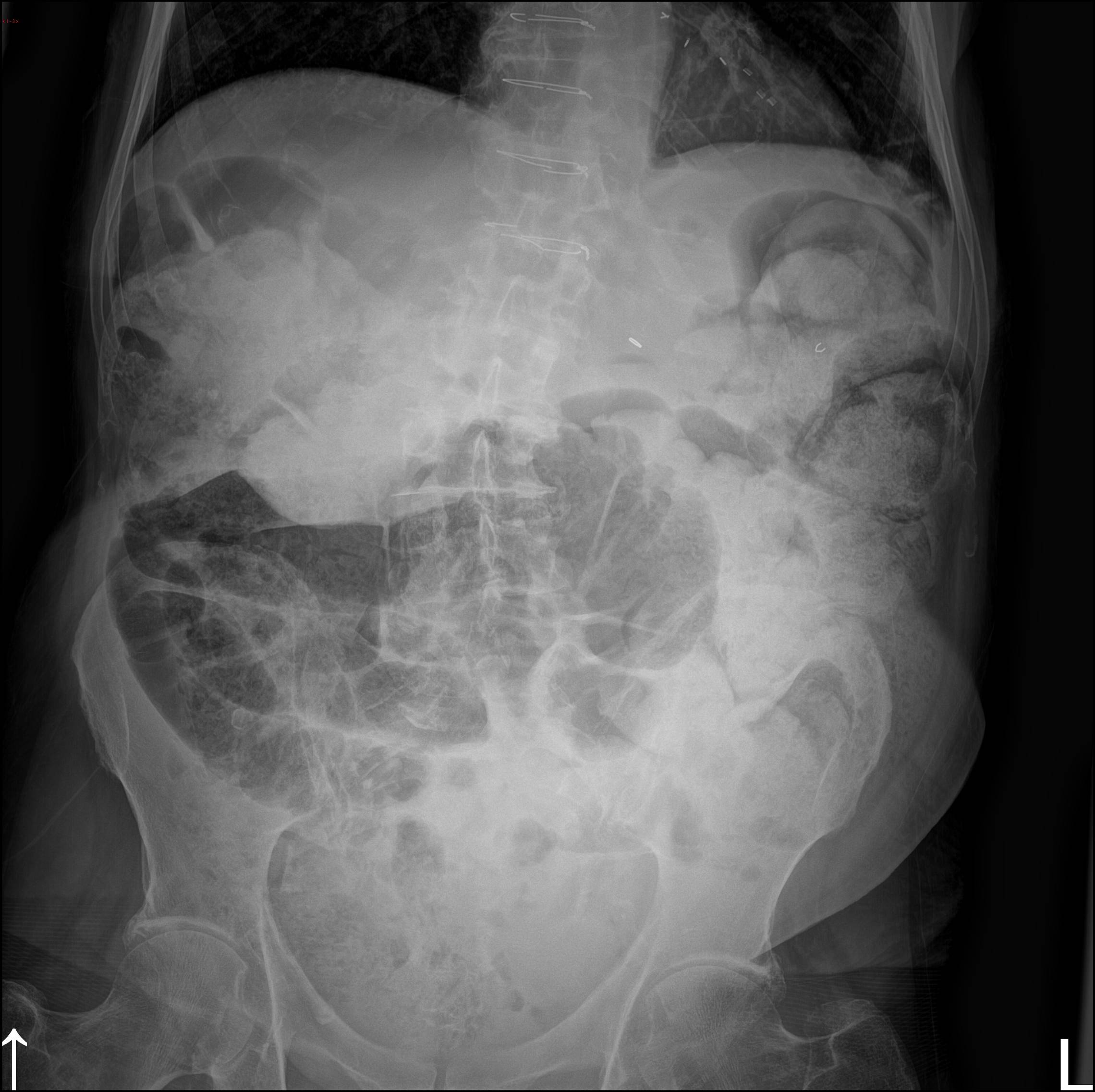 Wandering liver, dolichosigma, and paravertebral mass | Image ...