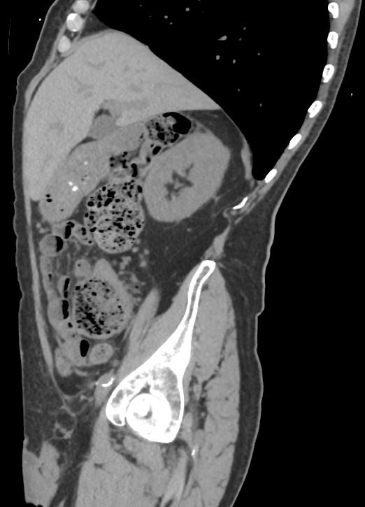 Wandering liver, dolichosigma, and paravertebral mass | Image ...