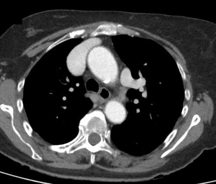 Partial anomalous pulmonary venous return | Radiology Case ...