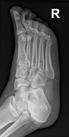 Multiple toe fractures | Radiology Case | Radiopaedia.org