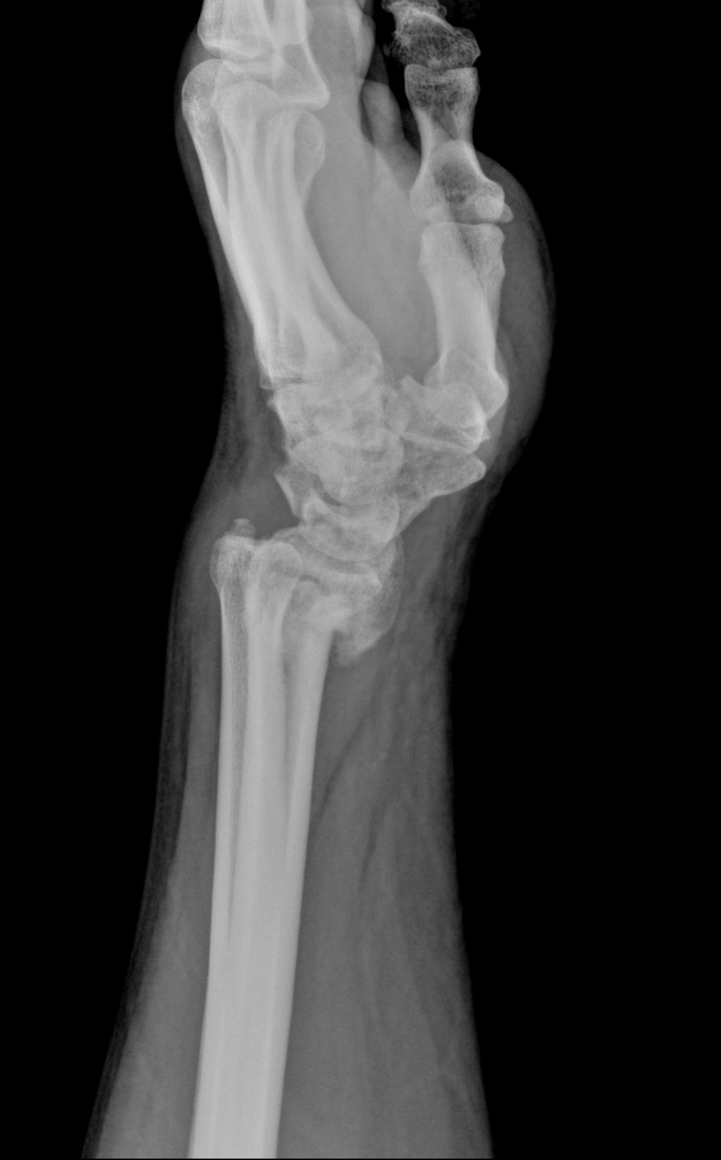 Smith Fracture Image 1838