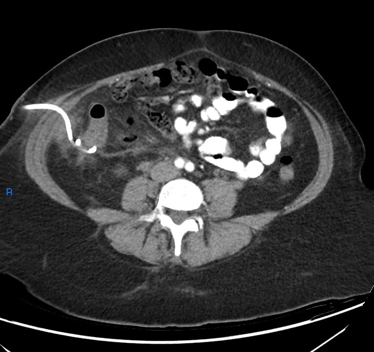 Appendicular Abscess | Image | Radiopaedia.org