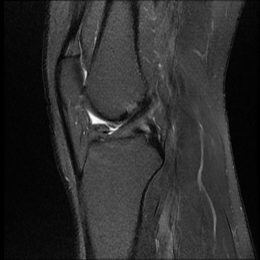 Discoid medial meniscus - bilateral | Image | Radiopaedia.org