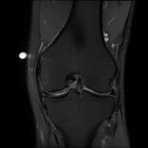 Horizontal meniscal tear with large parameniscal cyst | Image ...