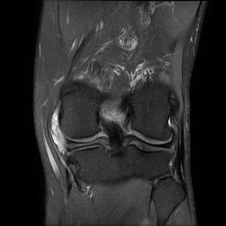 Horizontal meniscal tear with large parameniscal cyst | Radiology Case ...