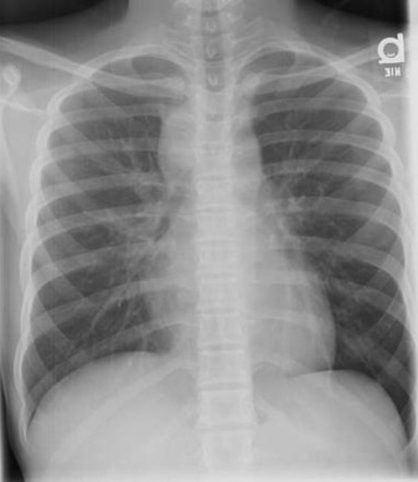 Pulmonary Tuberculosis | Radiology Case | Radiopaedia.org