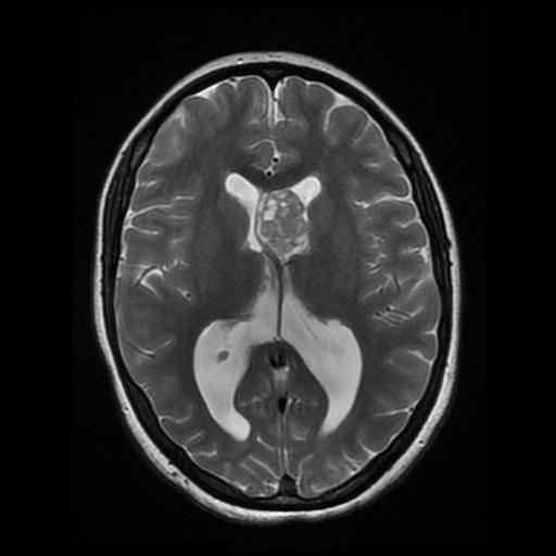 Subependymal Giant Cell Astrocytoma - Recurrence 