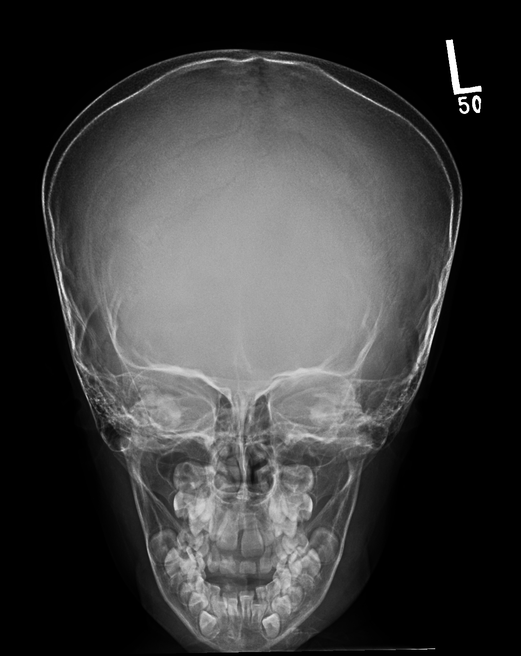 File Spondylometaphyseal Dysplasia Corner Fracture Type Radiopaedia 8505 9323 Towne View 1