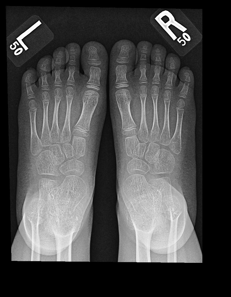 File:Spondylometaphyseal dysplasia, corner fracture type (Radiopaedia ...