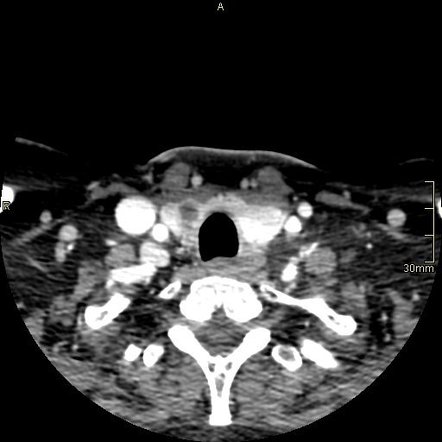 Figure 1 From External Jugular Vein Aneurysm Presenti - vrogue.co