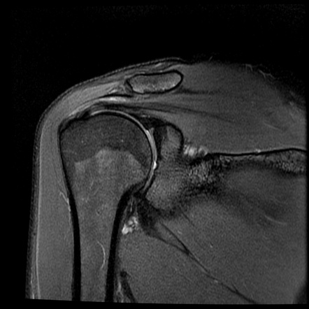 Tubercle of Assaki | Radiology Reference Article | Radiopaedia.org