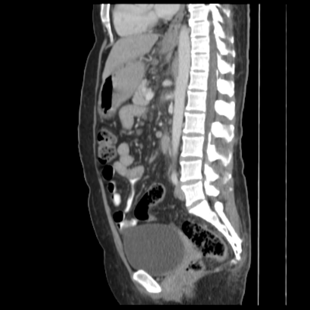 Primary biliary cholangitis | Image | Radiopaedia.org