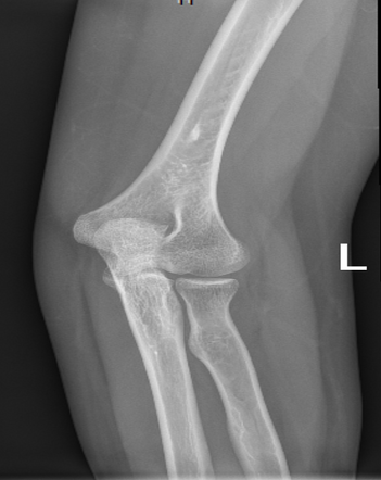 Avian spur | Image | Radiopaedia.org