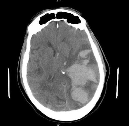 Subfalcine herniation | Radiology Case | Radiopaedia.org