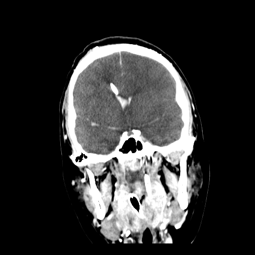 Brain death | Image | Radiopaedia.org