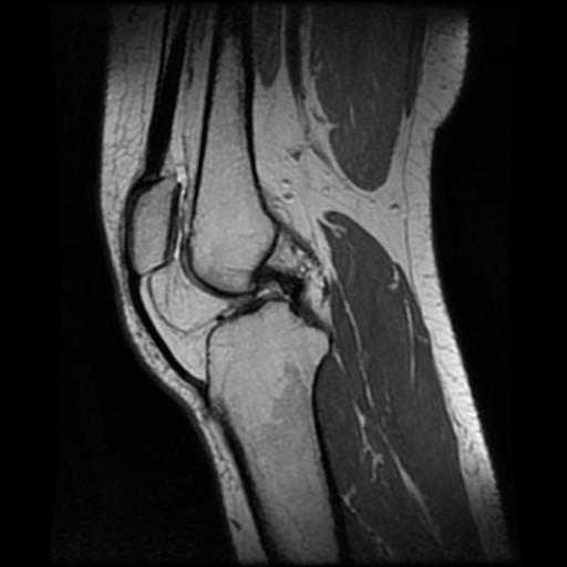 Intra-articular Lipoma - Knee 