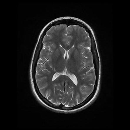 Cerebellar pilocytic astrocytoma - recurrence | Radiology Case ...