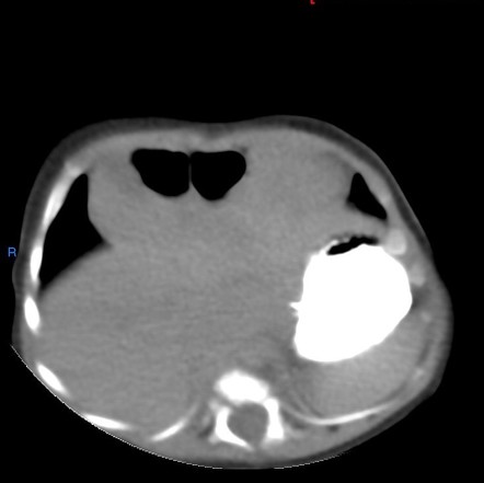 Morgagni hernia | Image | Radiopaedia.org