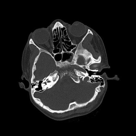 Tuberculous osteomyelitis of the clivus | Radiology Case | Radiopaedia.org