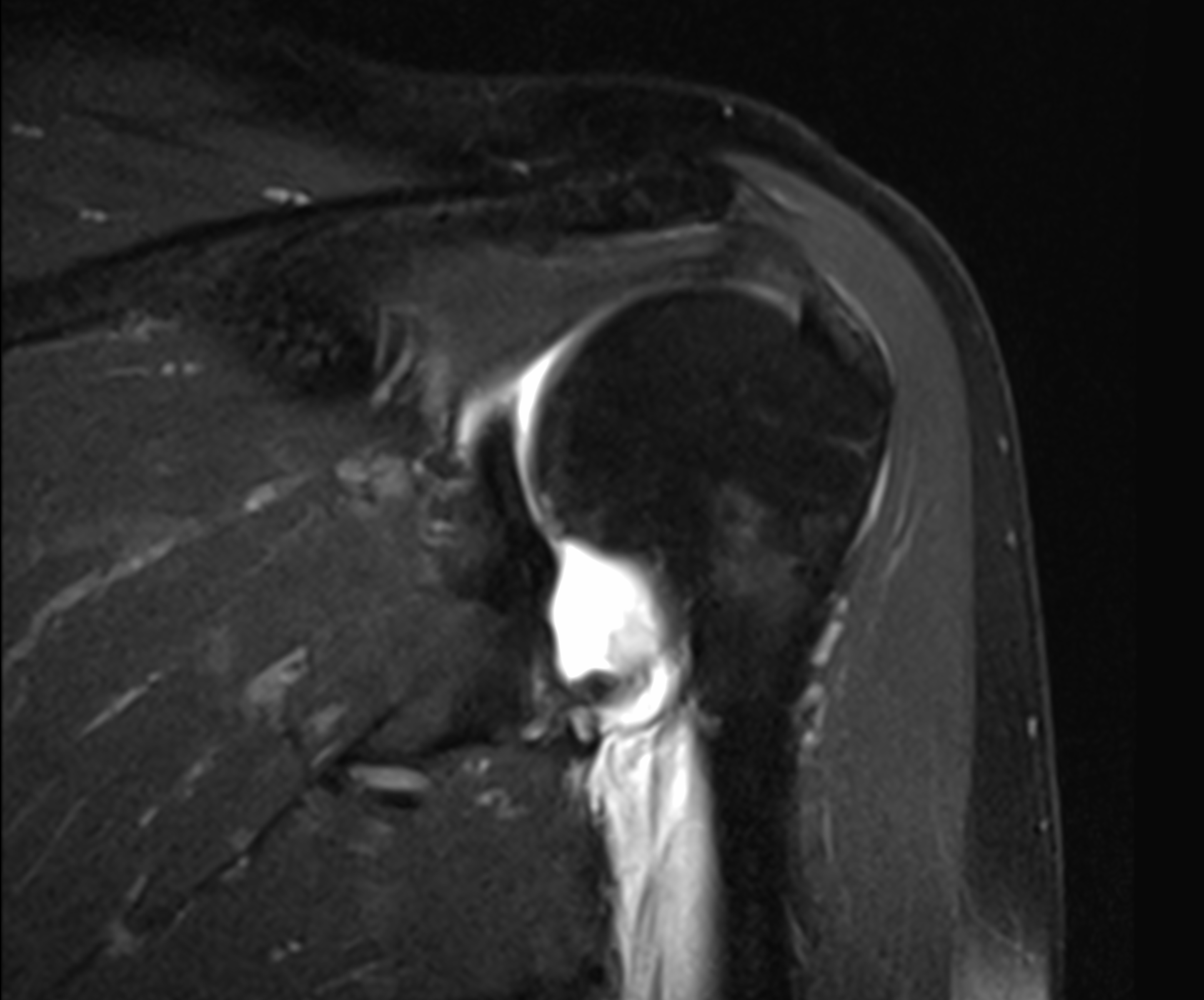 Humeral Avulsion Of Glenohumeral Ligament (HAGL) Lesion | Image ...