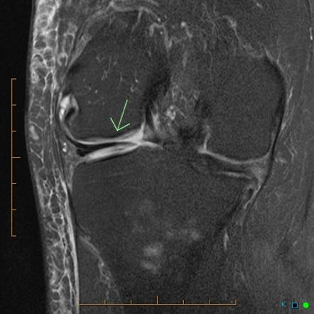 Discoid meniscal flounce | Image | Radiopaedia.org