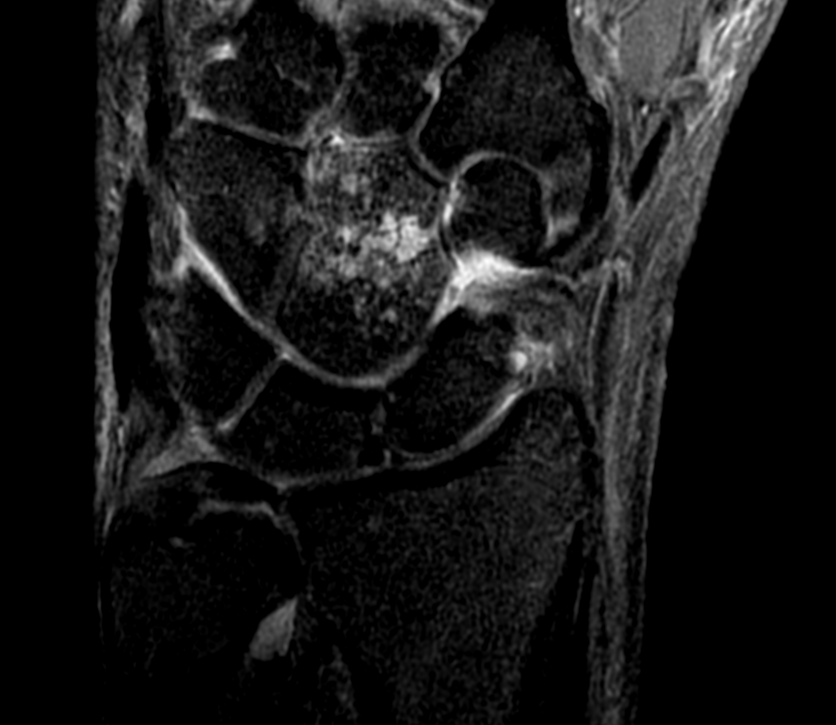 Isolated capitate fracture | Image | Radiopaedia.org