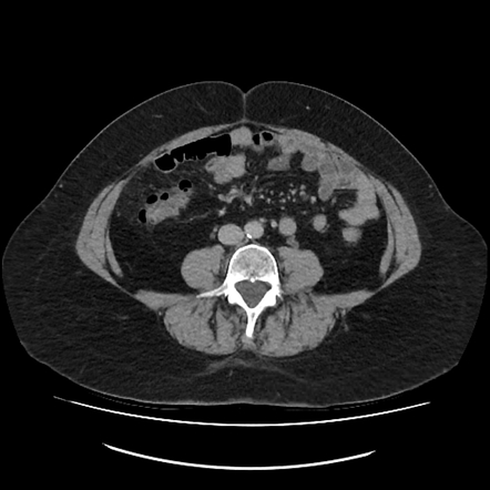 Appendiceal Mucocele | Radiology Case | Radiopaedia.org