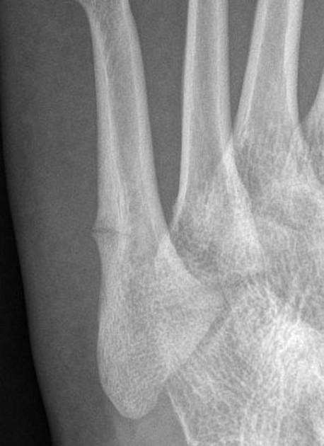 Sports Injury Bulletin - Anatomy - Fractures of the Proximal 5th Metatarsal  in Athletes