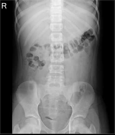 Appendicolith Radiology Case Radiopaedia Org