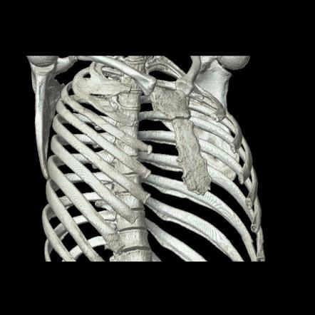 Congenital rib fusion | Radiology Reference Article | Radiopaedia.org