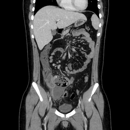 Perforated appendicitis with large abscess | Radiology Case ...