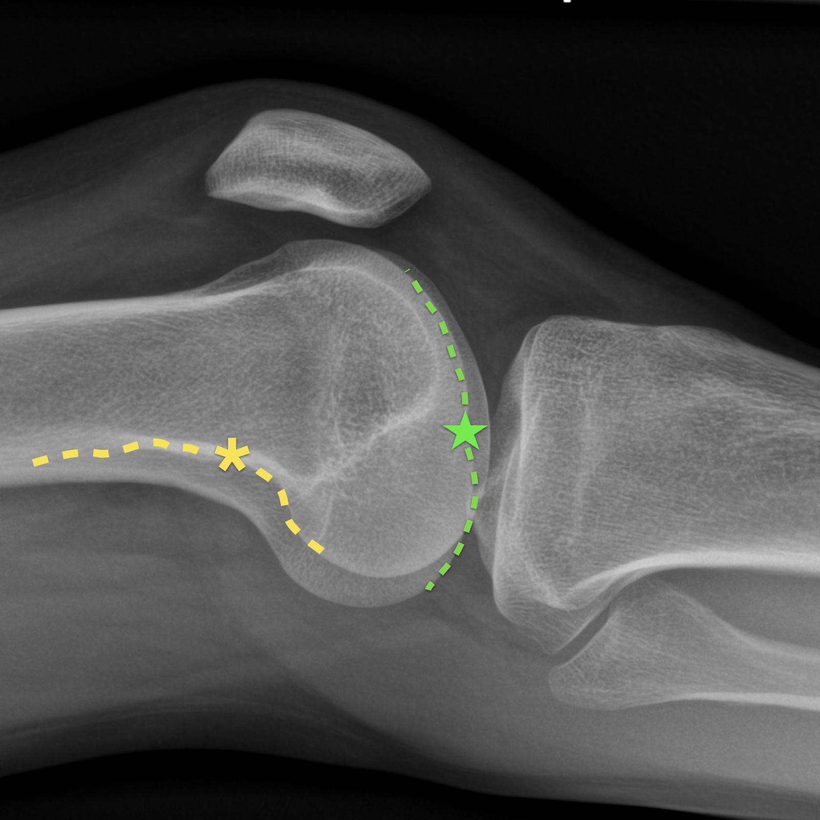 Lateral knee positioning | Image | Radiopaedia.org