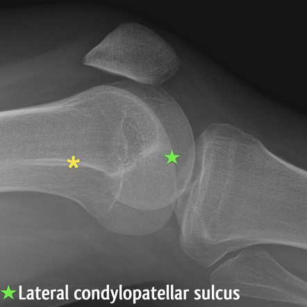 Lateral knee positioning | Image | Radiopaedia.org