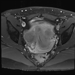 Diffuse Uterine Leiomyomatosis | Image | Radiopaedia.org