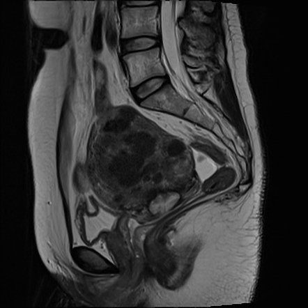 Diffuse uterine leiomyomatosis | Image | Radiopaedia.org