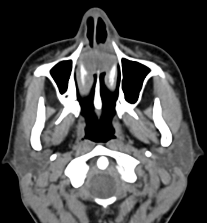 Nasopalatine duct cyst (NPDC) | Image | Radiopaedia.org