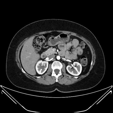 Intravenous Contrast Medium Administration and Scan Timing at CT:  Considerations and Approaches