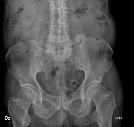 Ossification of iliolumbar ligament in ankylosing spondylitis | Image ...