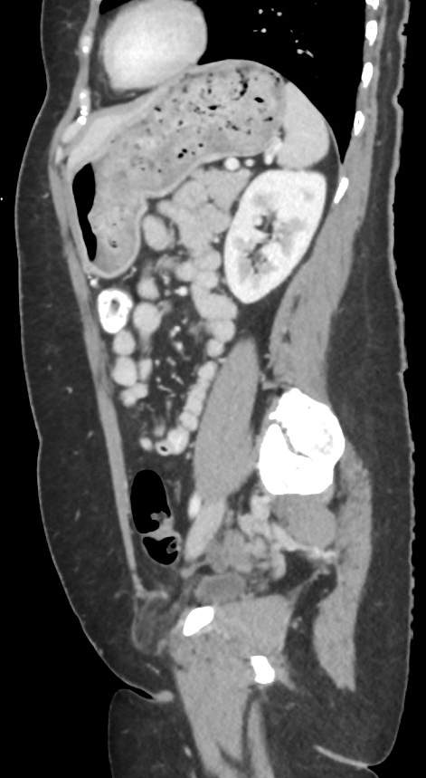 Incarcerated Fat Containing Femoral Hernia Image Radiopaedia Org